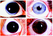 Four representative slides of corneal arcus.jpg