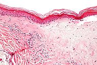 Lichen sclerosus - high mag.jpg