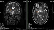 MRI glioma 28 yr old male.JPG