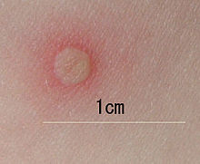 Chickenpox blister-(closeup).jpg