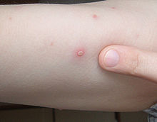 Chickenpox blister 2006.01.06.jpg