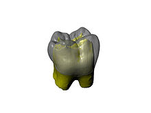 Reconstruction virtuelle d'une dent
