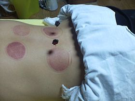Moxibustion lors d'une séance d'acupuncture